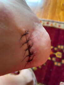 Foot laceration caused by the storm door