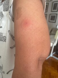 Bed bugs bites
