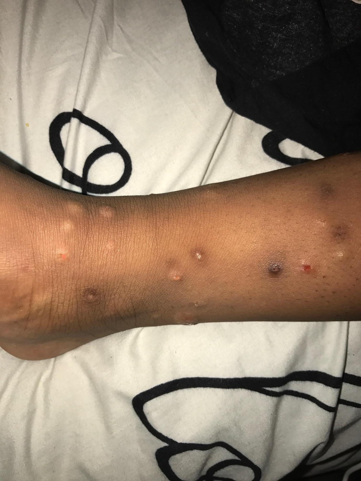 bites