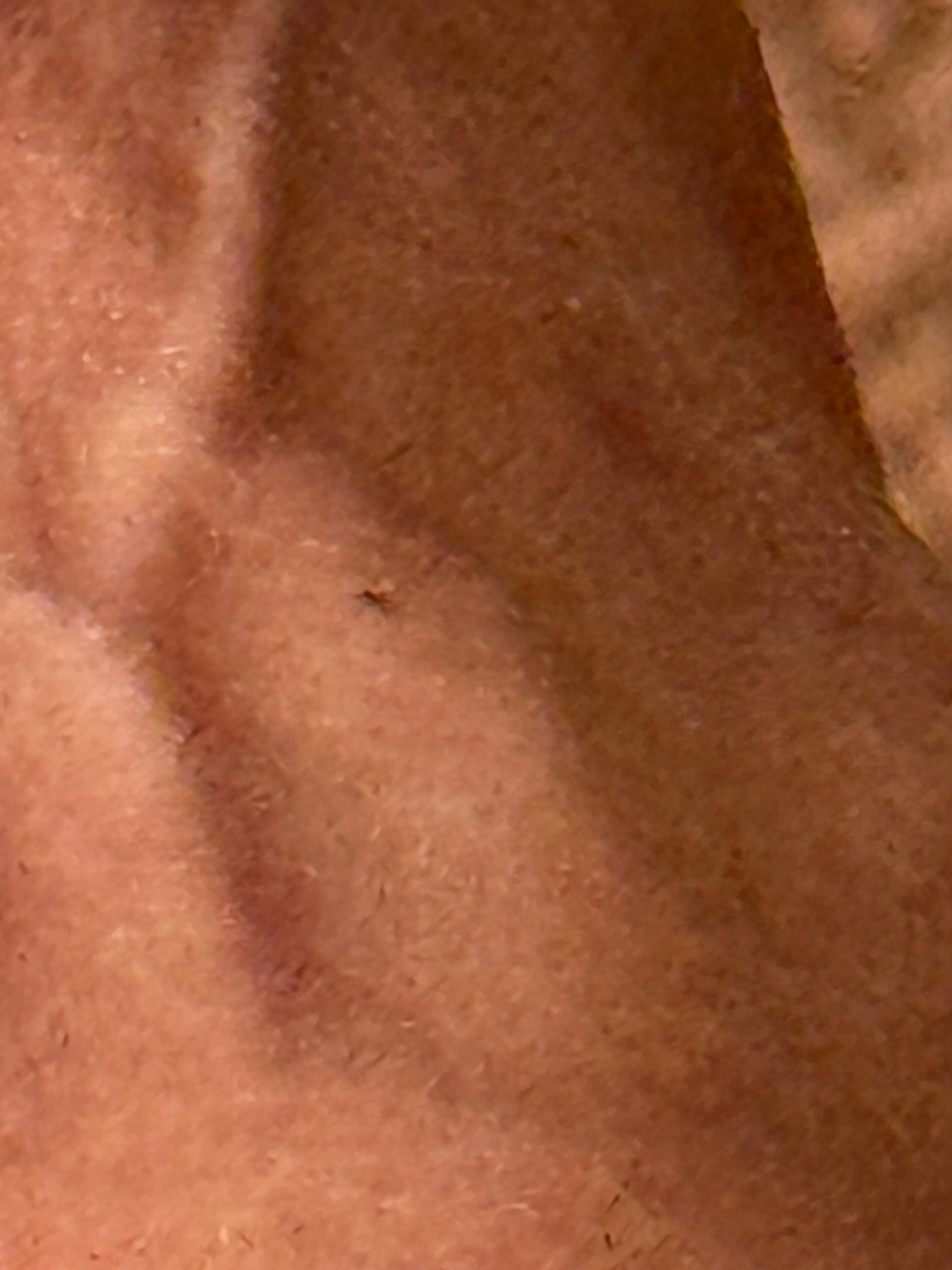 Swollen area with dark spot in the middle.