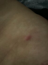Bug bite on torso