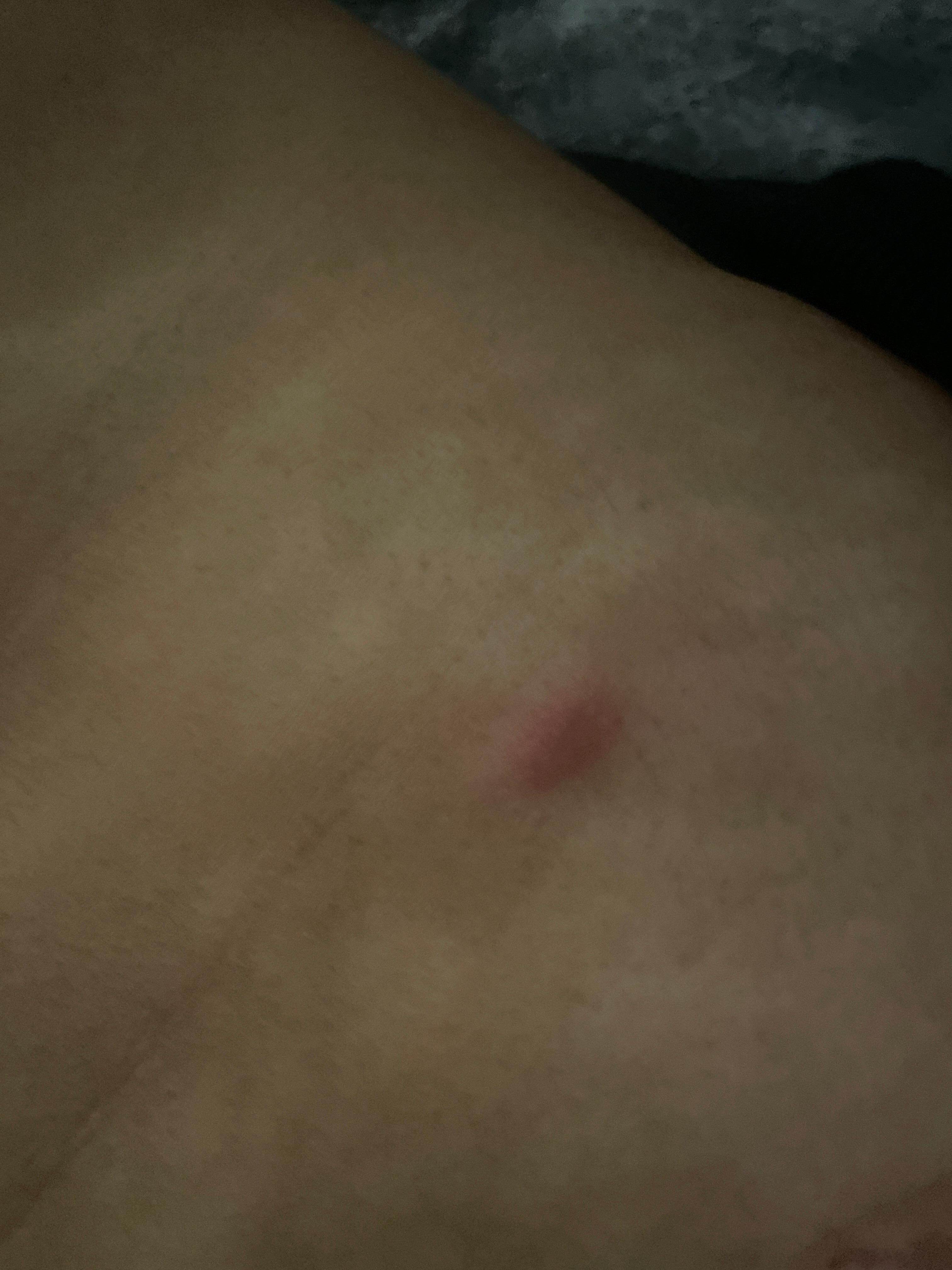 Bug bite on torso
