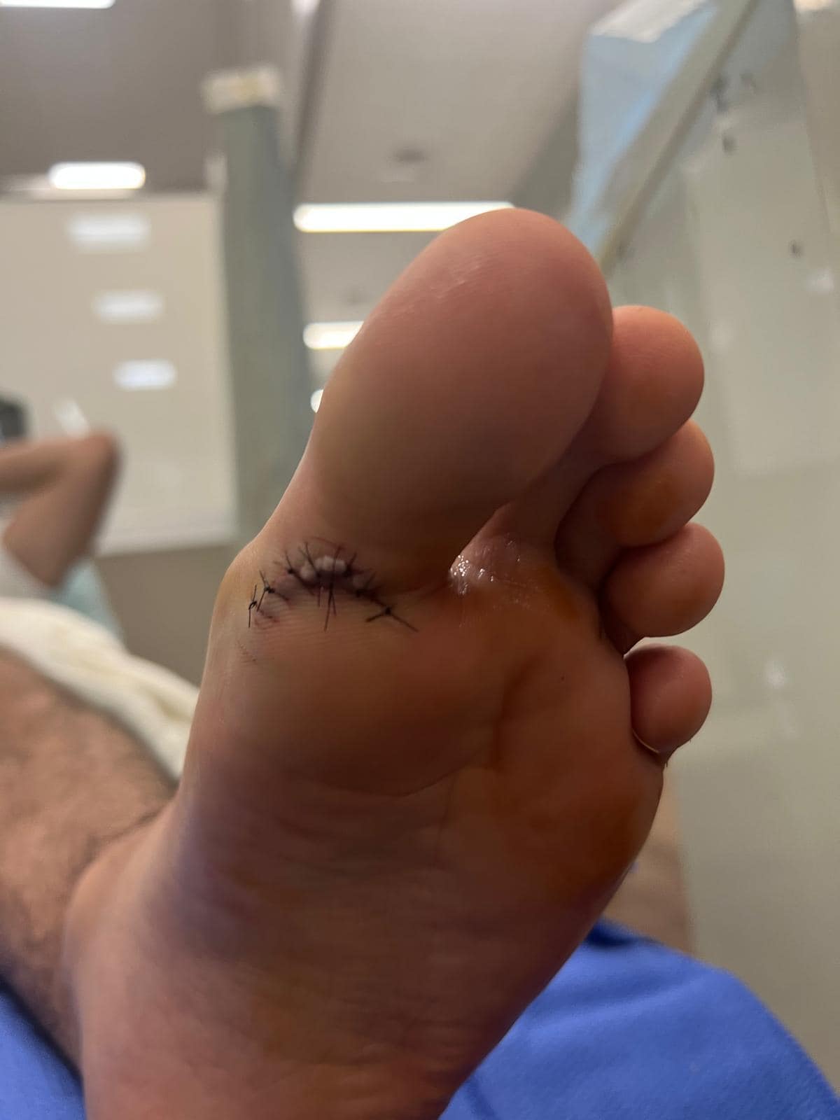 Eight stitches caused by the injury.