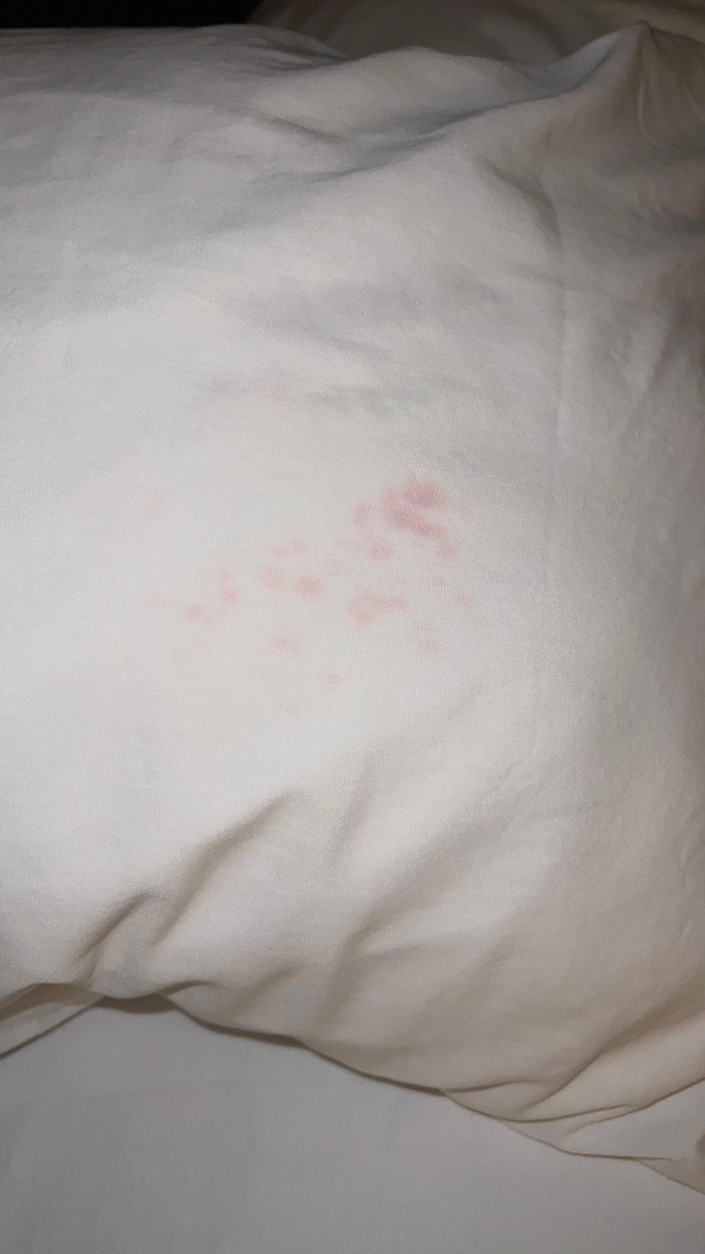 Fresh blood on a pillowcase.