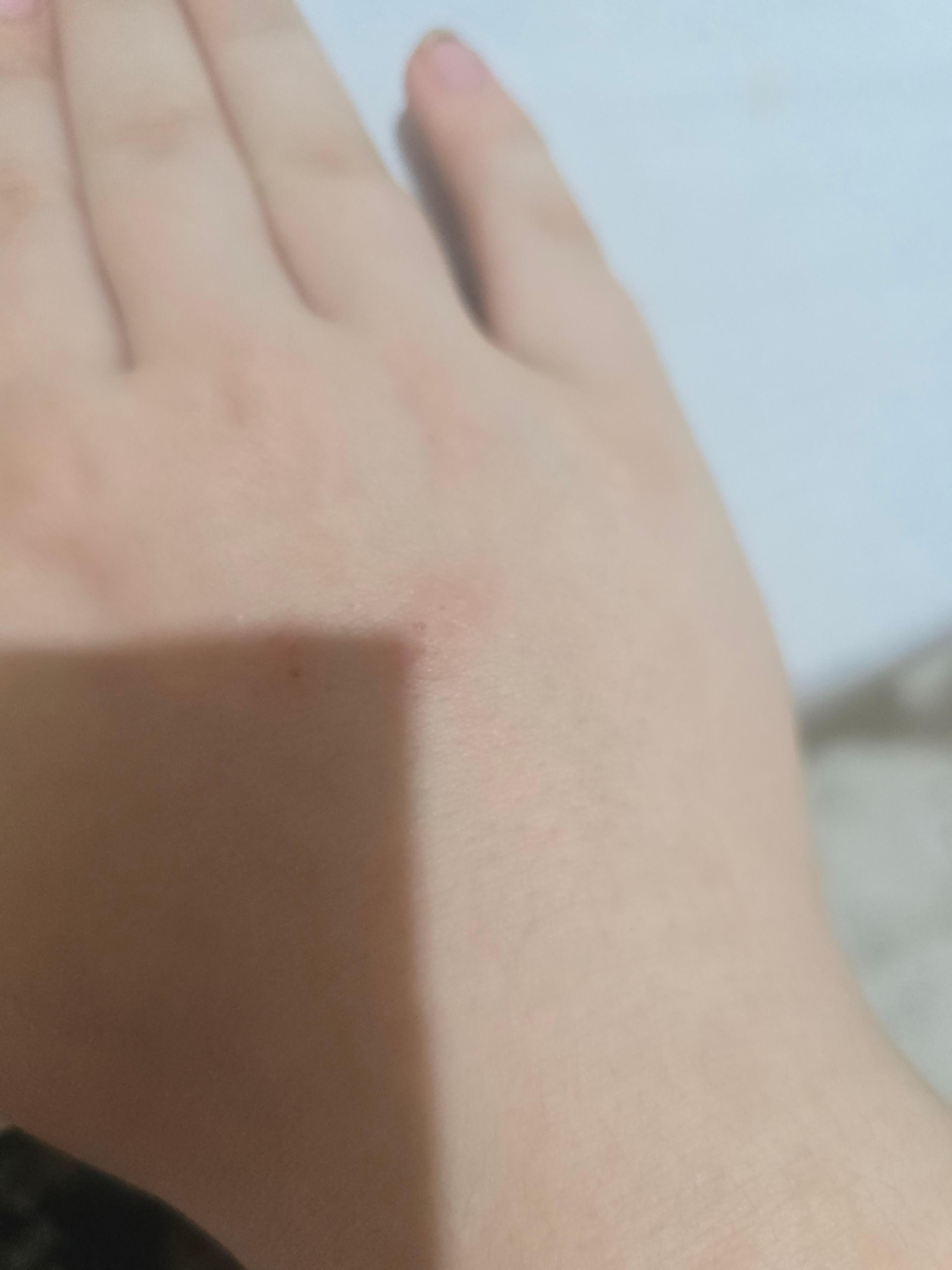 From the hotel bed bugs 