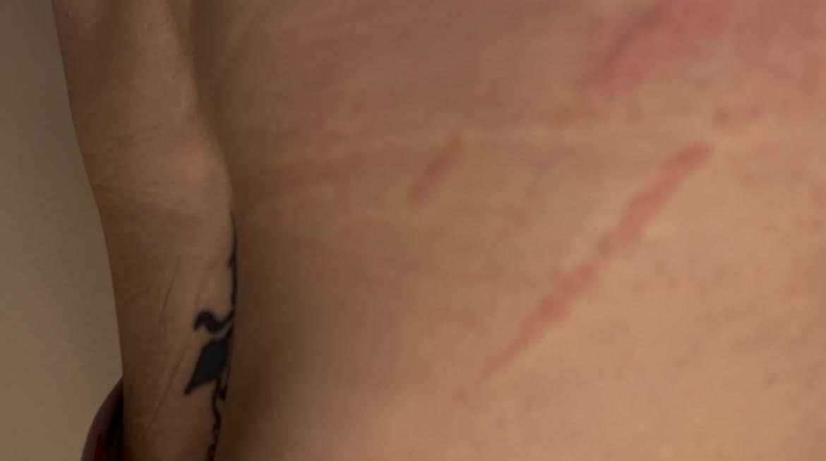 Bed bug bites and reaction 