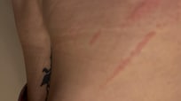 Bed bug bites and reaction