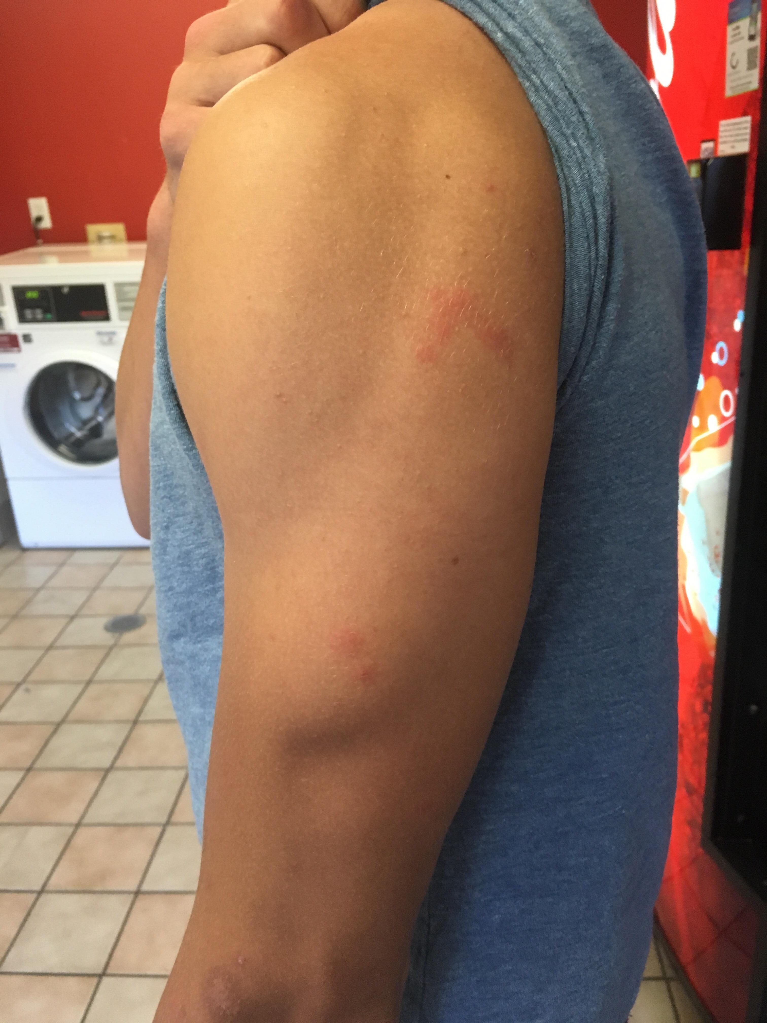 Red bed bug bites. Yuck