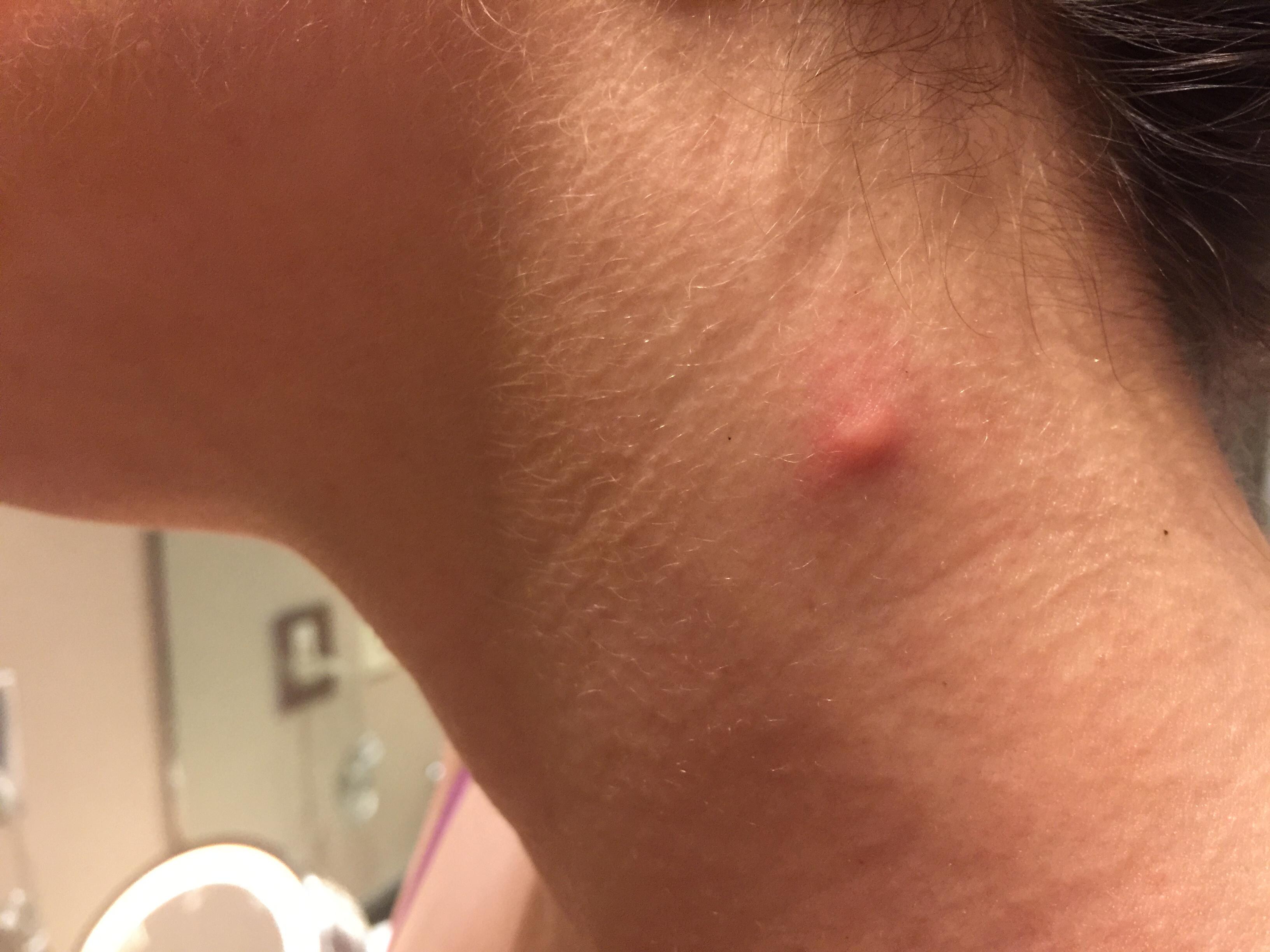 Bed bug bite