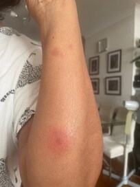 Bed bugs bites