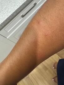 Bedbug bites