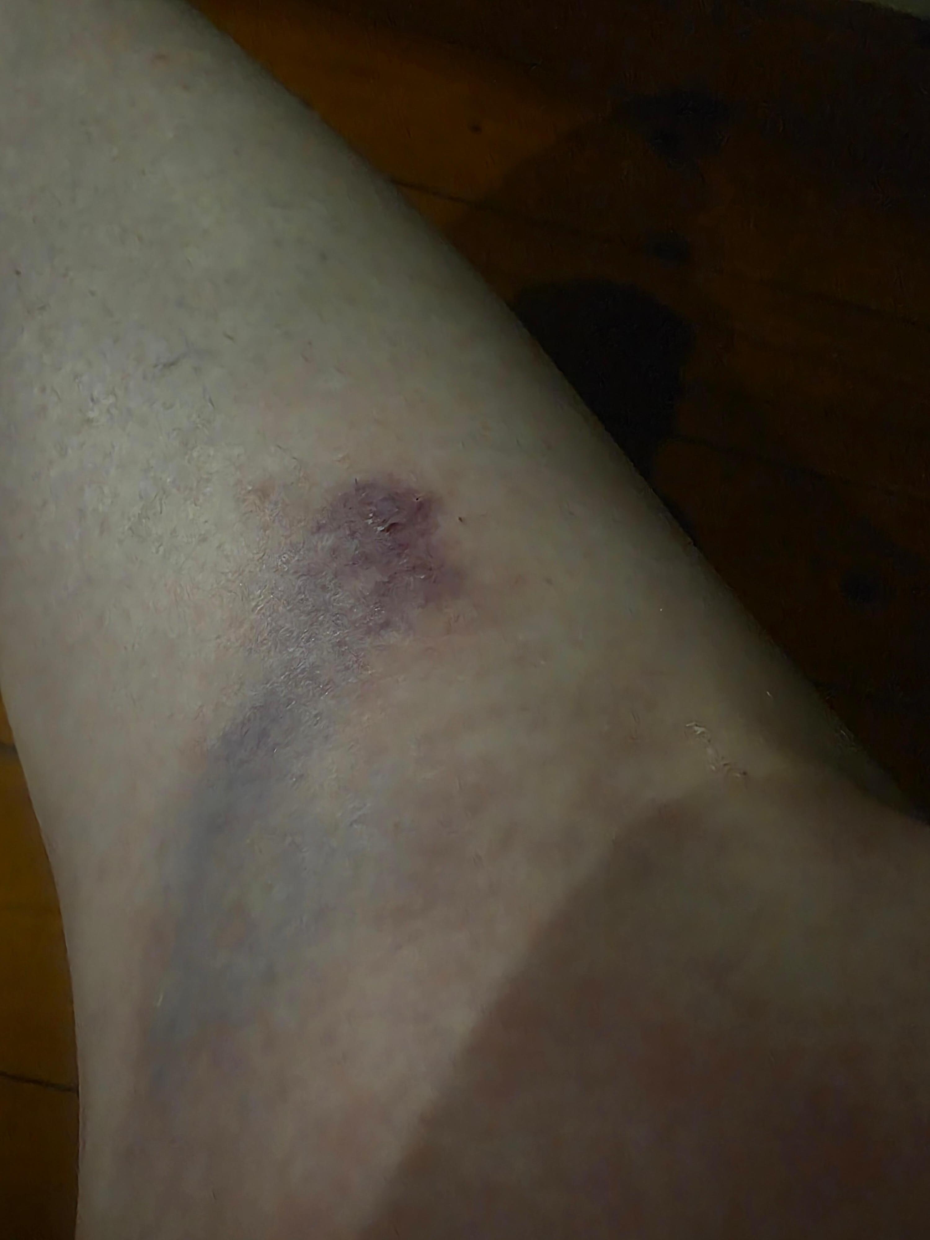 My shin after ladder slipping.