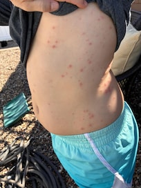 This is only one side of just her stomach. Imagine this everywhere else on her body as well.