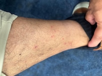Bites from bed bugs