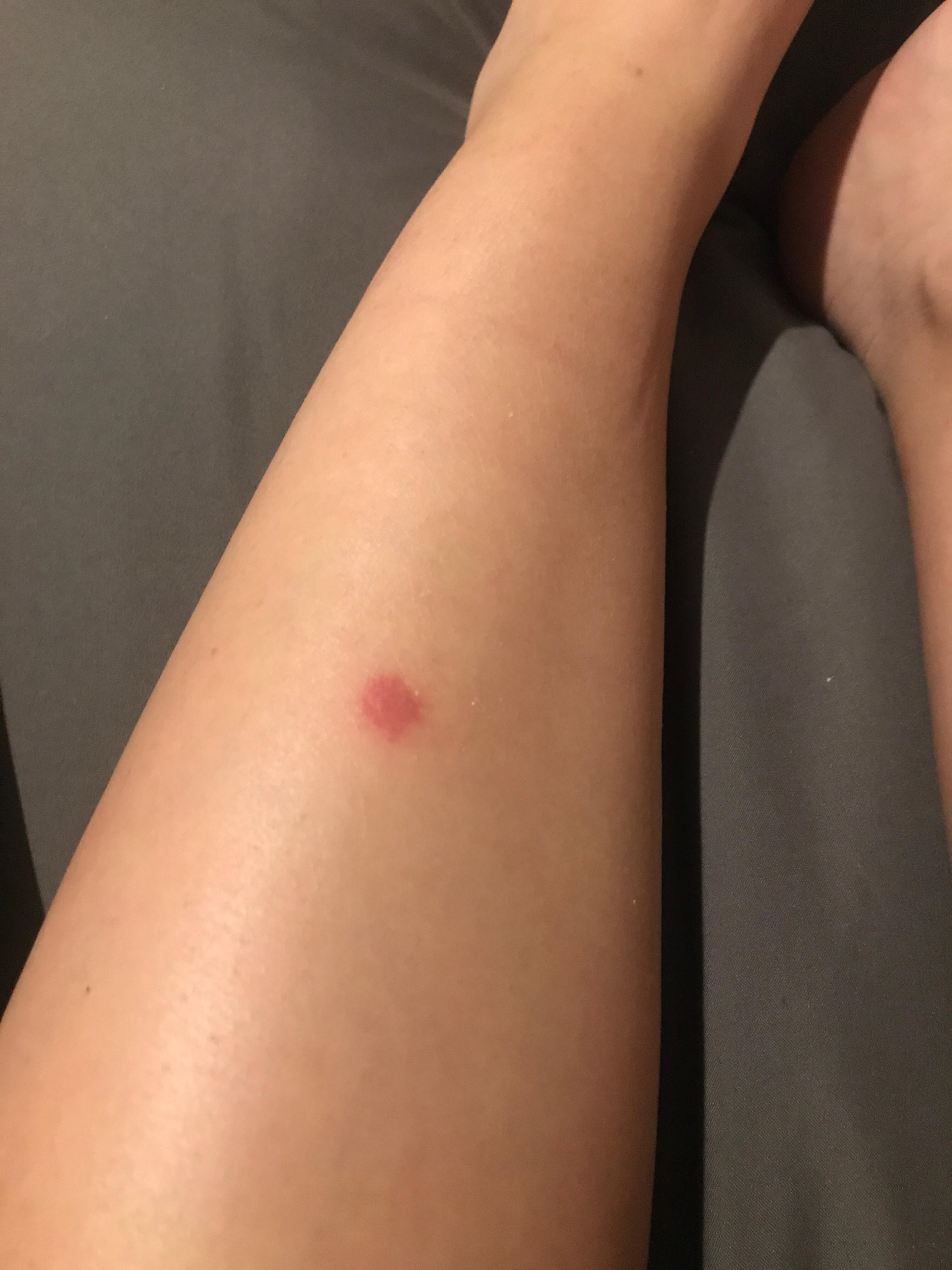 Bed bug bites