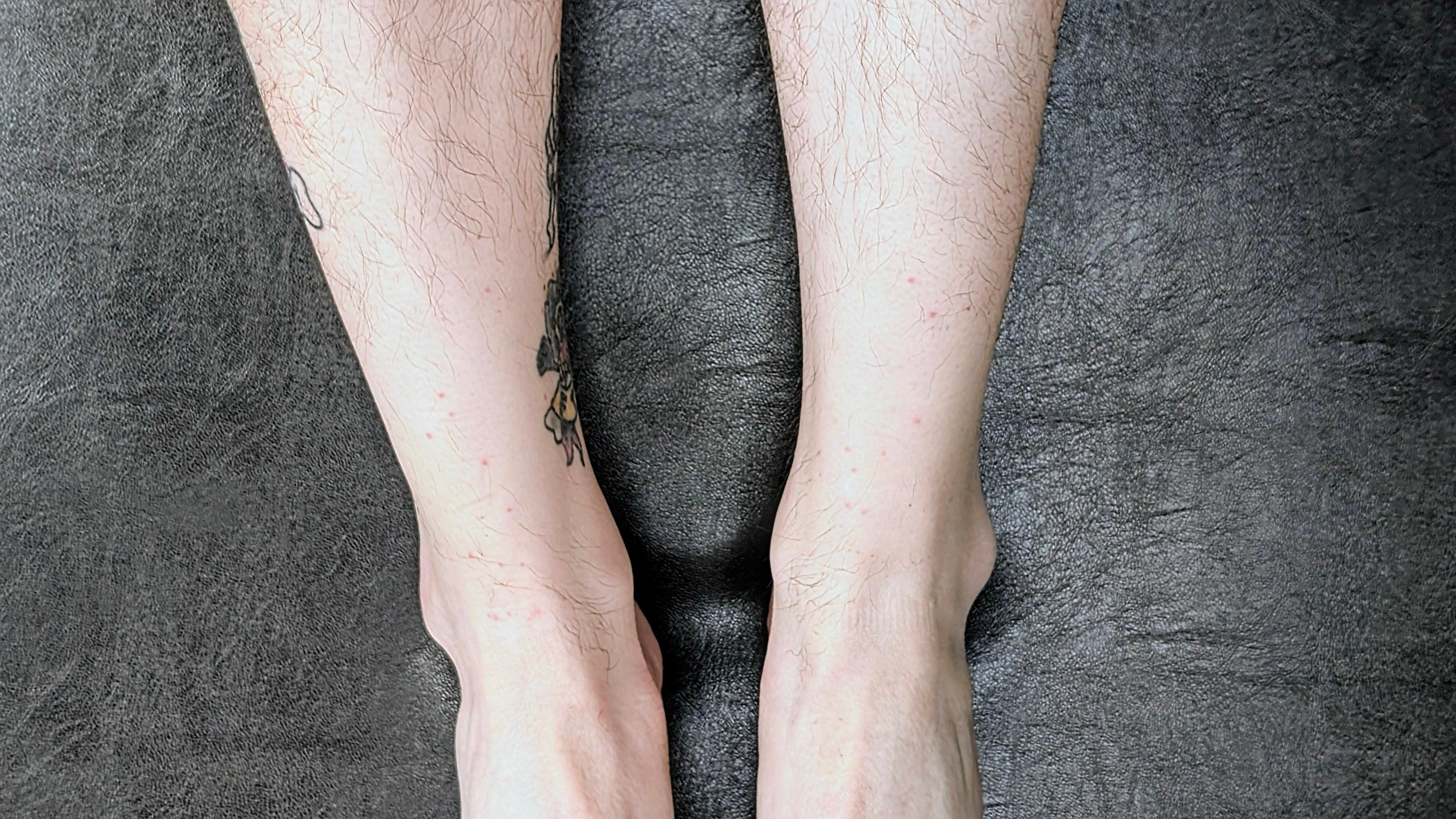 Flea bites after 1 night. 