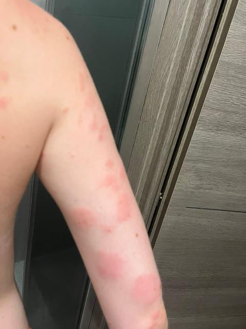 Réaction aux punaises de lit