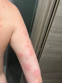 Réaction aux punaises de lit