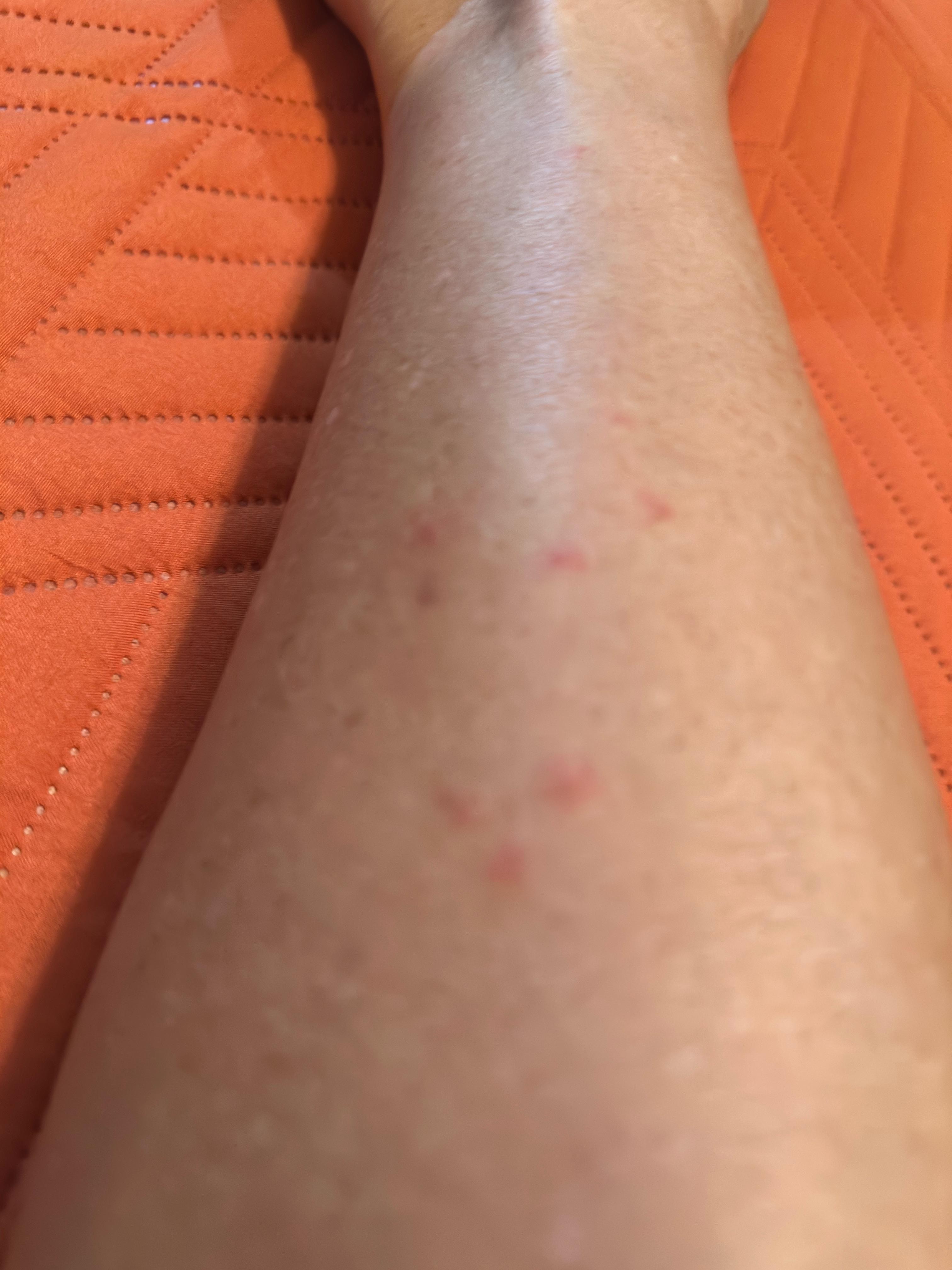 Flea bites from couch. After one hour.