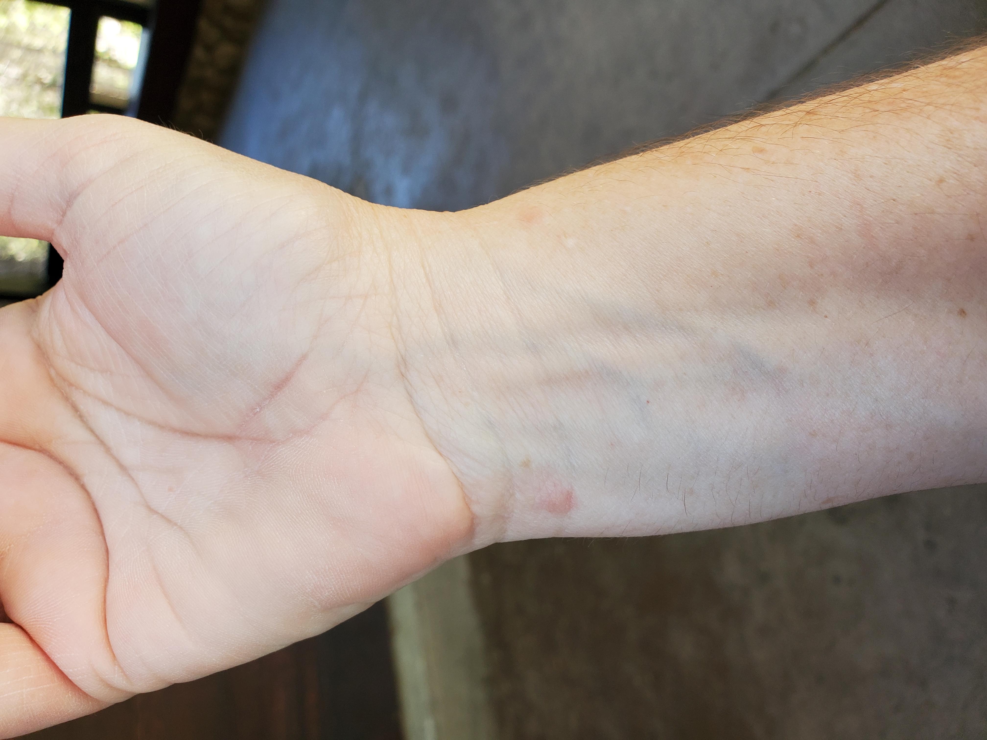 Bed bug bites on wrist