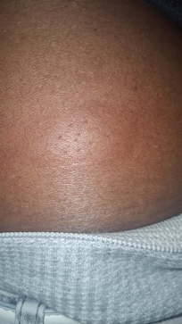 He got welps from being bit