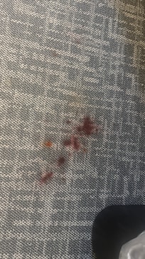 Blood stain on carpet