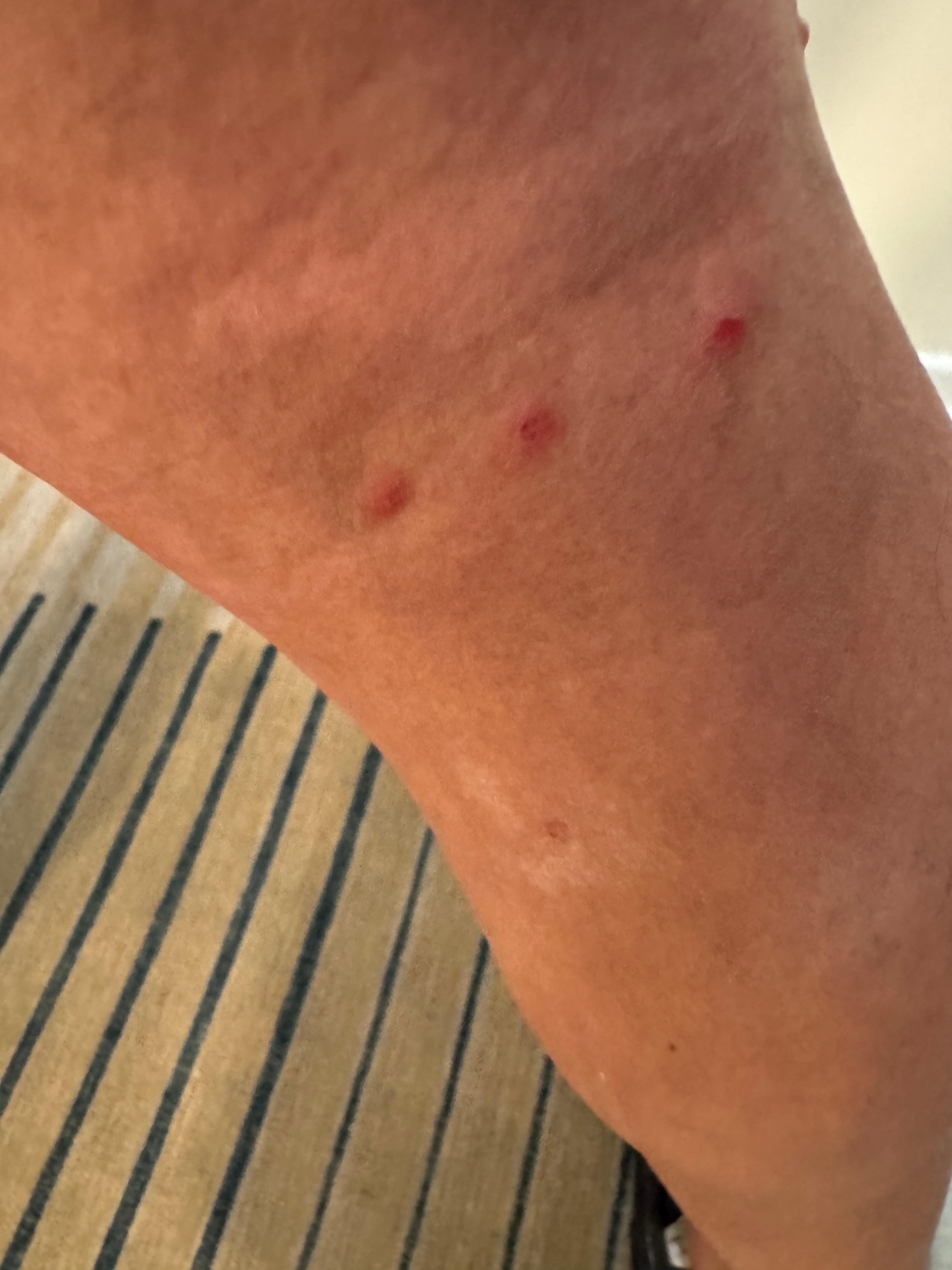 Bed bug bites