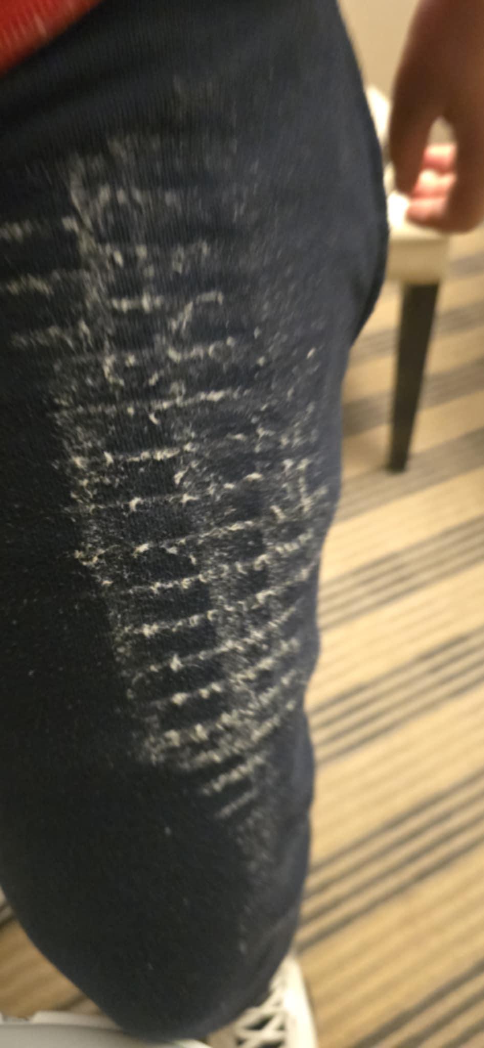 my sons leg after touching the dirty box fan they gave us