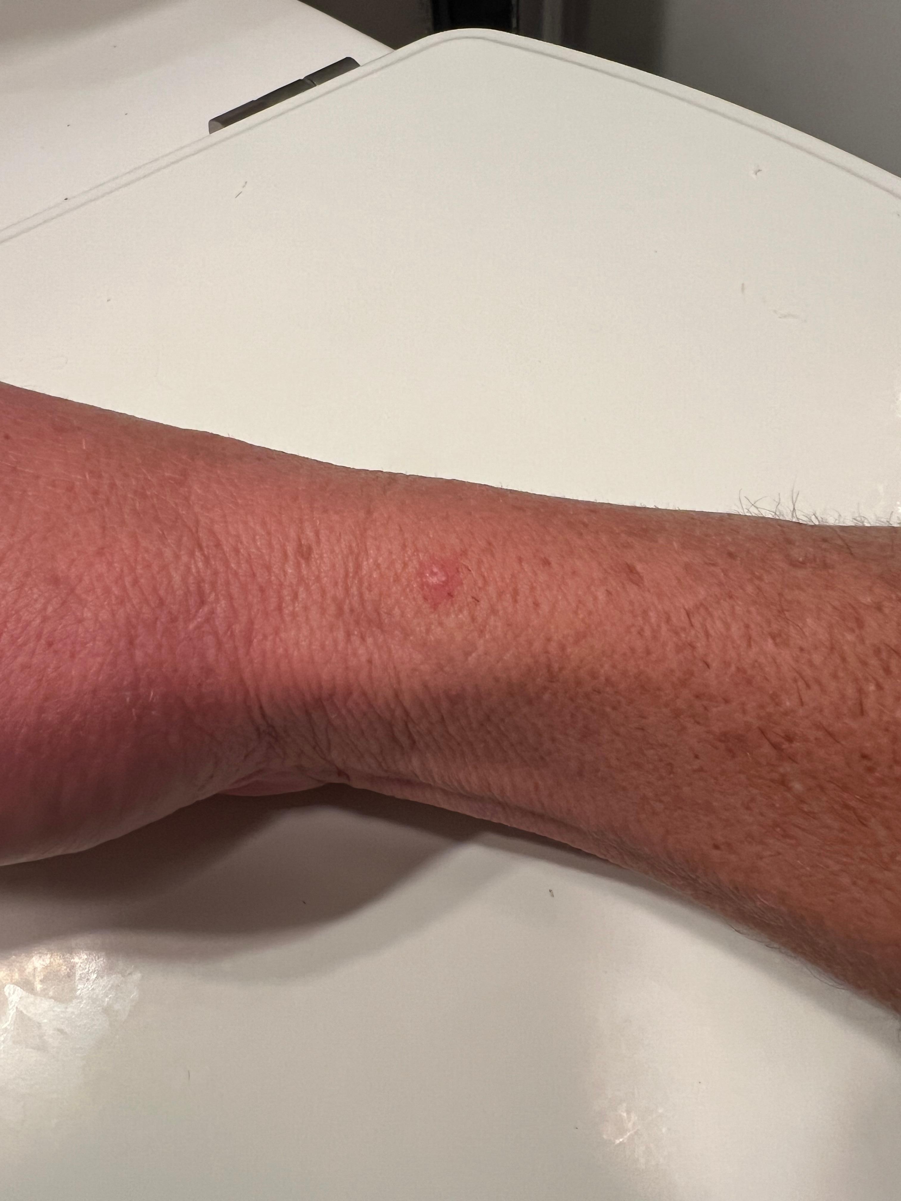 bite (bed bug??) appeared hours after checking out