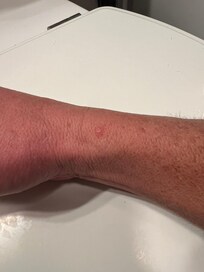 bite (bed bug??) appeared hours after checking out