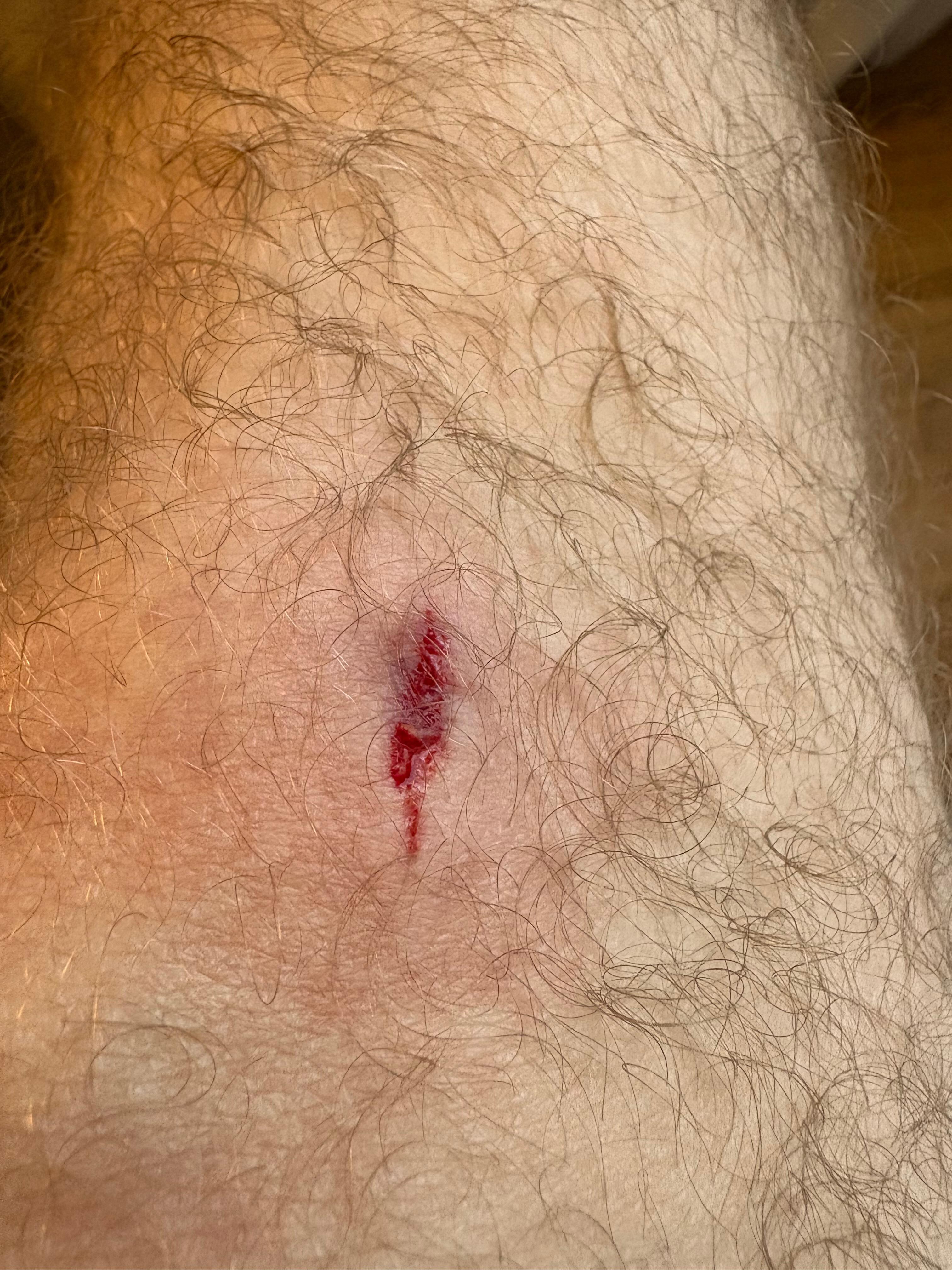 Leg blessure in the shelf