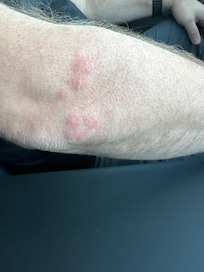 Bed bug bites