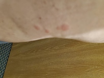 Bed bug bites on leg