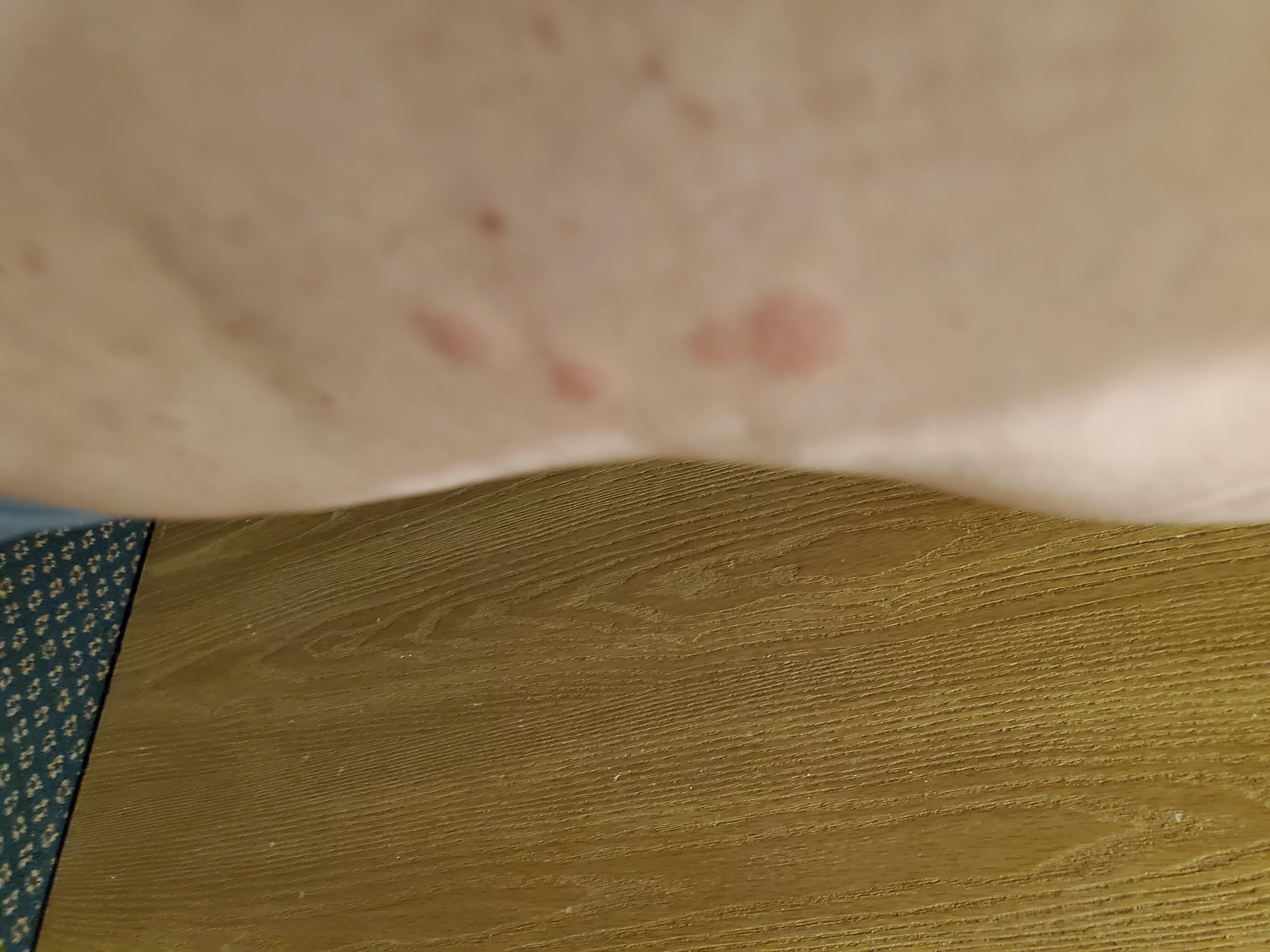 Bed bug bites on leg