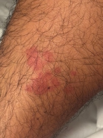 Random rash I woke up with after my first and only night spent in this horrible place!