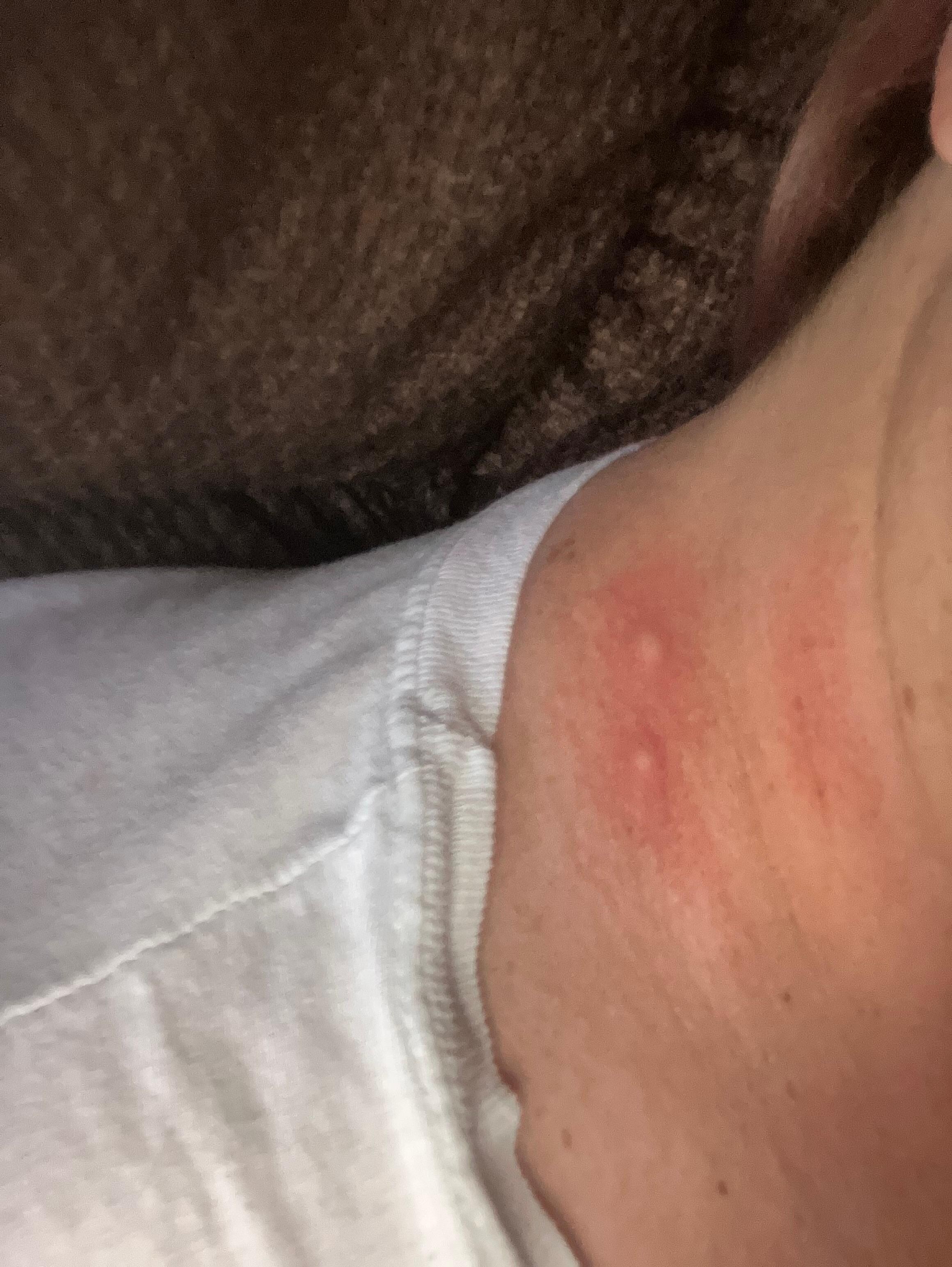 Just a sample of the bug bites. We all have multiples. 