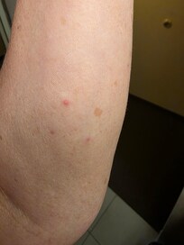 Ant bites from the room