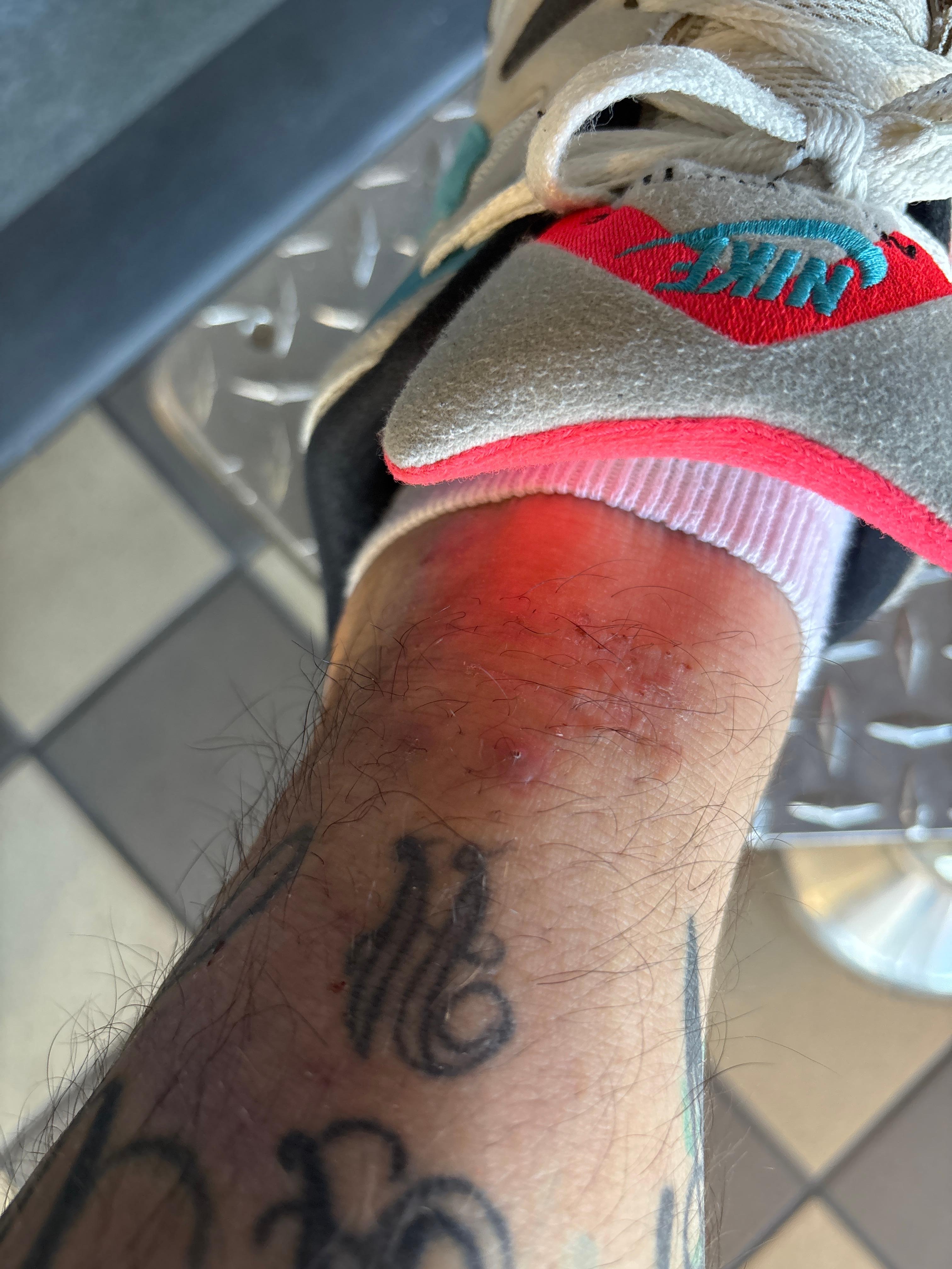 This started the first night and I’ve been scratching nonstop 