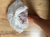 Foot injury due to fall