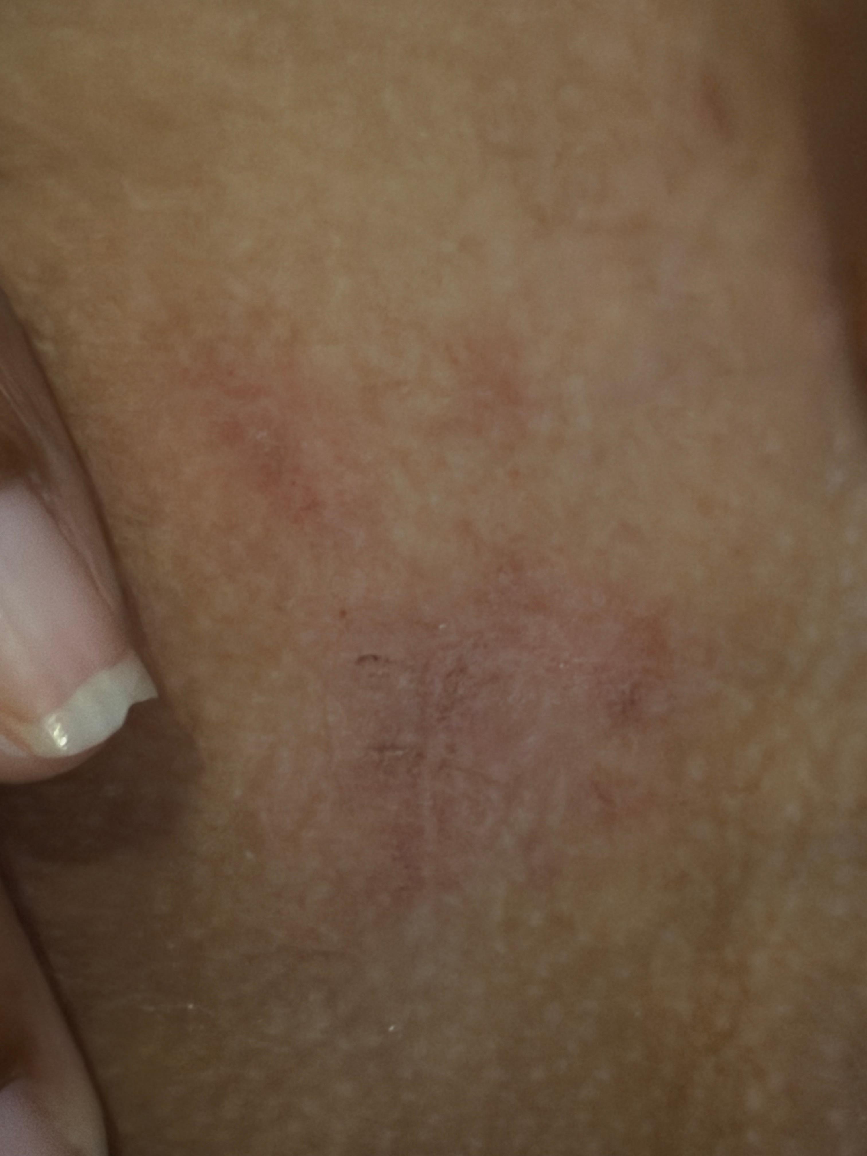 My son broke out in a rash