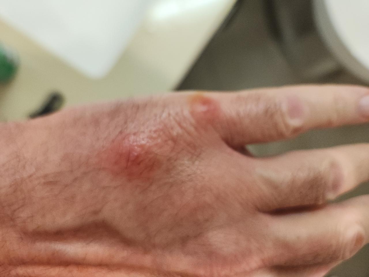 My hand a few hours after the bites.