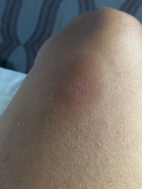 Bedbug bites