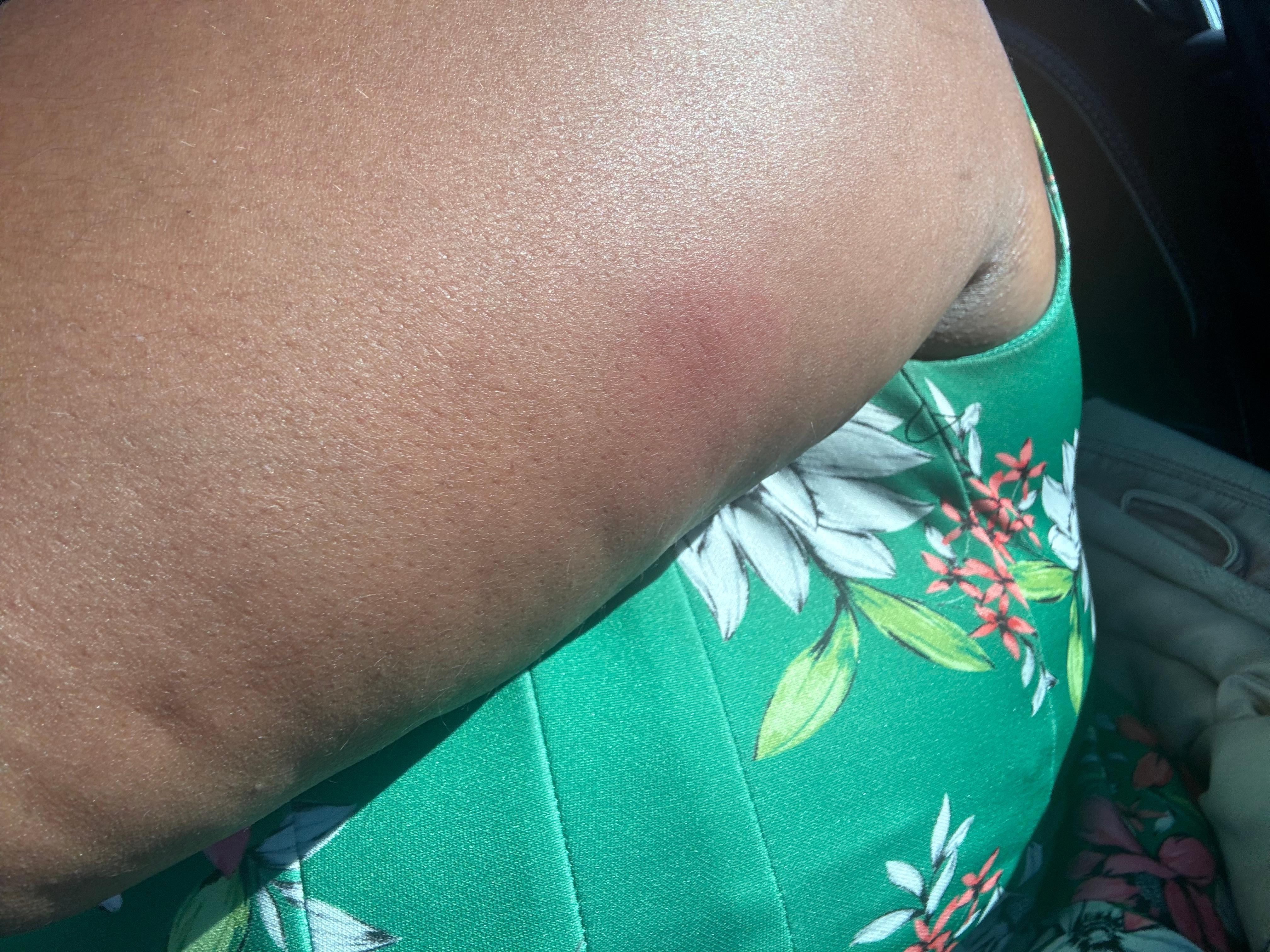 Bed bug bites after staying this weekend 