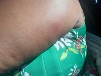 Bed bug bites after staying this weekend