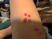 These were the deepest bites. Up close, you can see how deep they are.