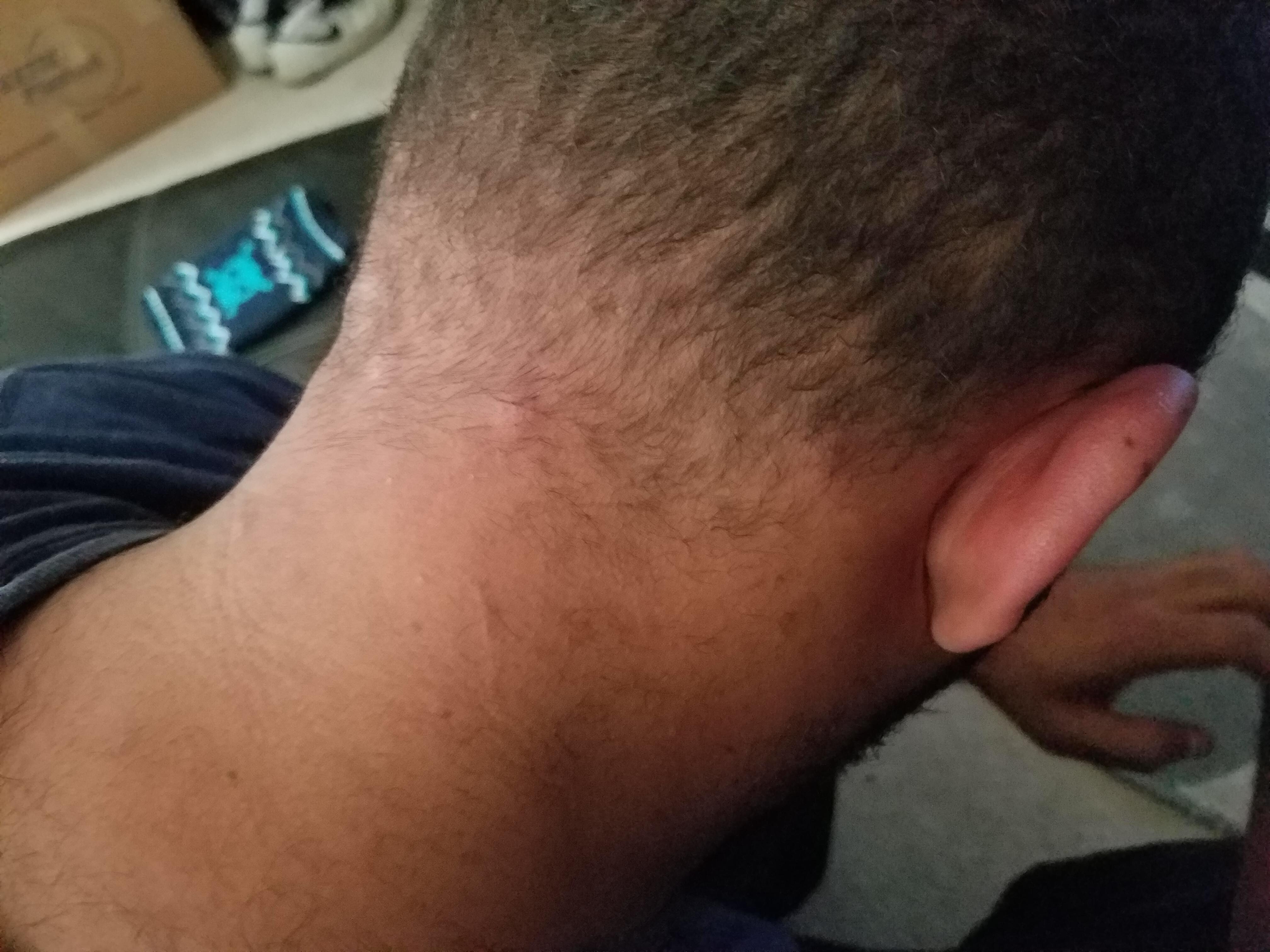 Bite malls on my neck from staying at this hotel