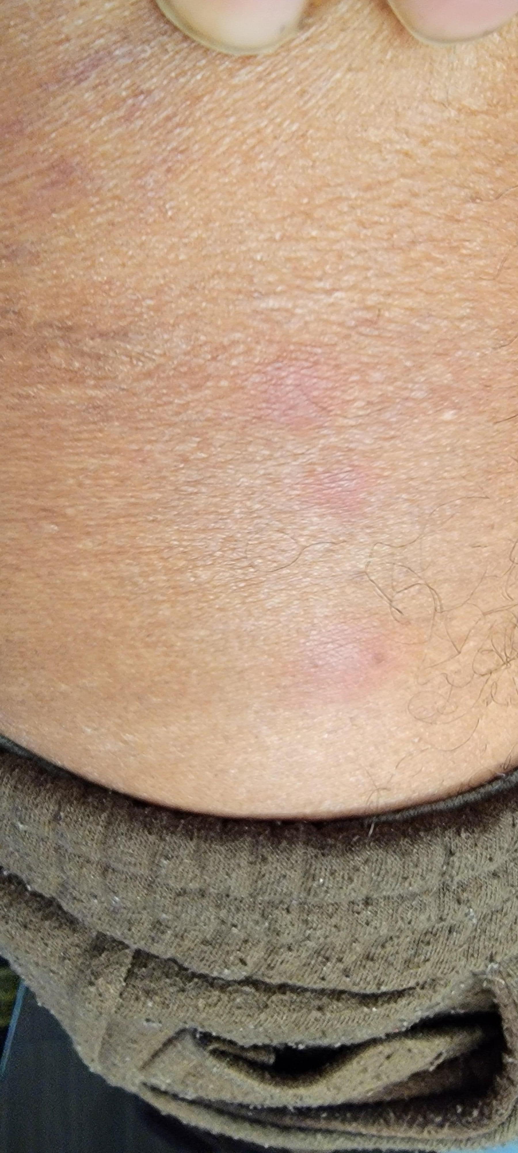 bites on my waste line