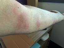 Bites Right Arm