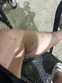 Bug bites on first night on my left leg
