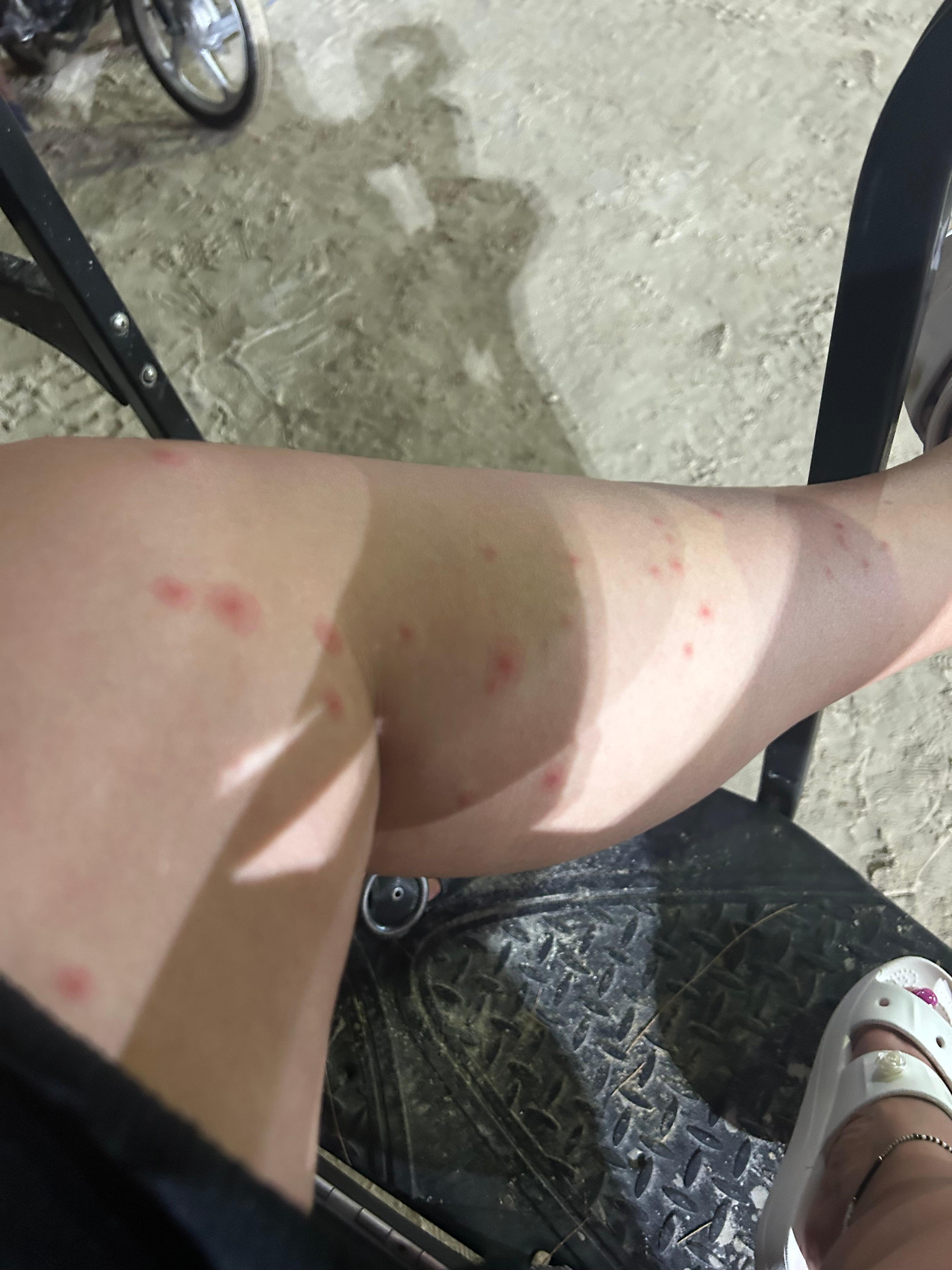 Bug bites on first night on my left leg